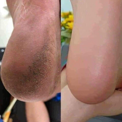 Bộ dụng cụ chà gót chân ,làm sạch da chết kèm lưỡi dao cạo và hộp đựng thiếc xinh xắn 