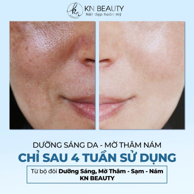 [Mẫu cũ] Bộ 2 sản phẩm Trắng Da Ngừa Nám KN Beauty: Kem dưỡng 10g + Serum 30ml