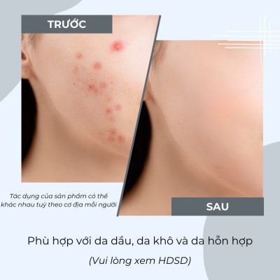 Mặt Nạ Đất Sét Tro Núi Lửa JeJu Ngừa Mụn Sạch Sâu POP