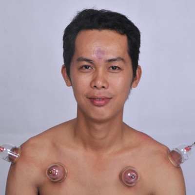 Bộ Giác Hơi Không Dùng Lửa Duy Thành YGH02