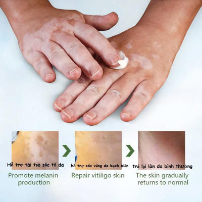 [Vilitigo] Kem Bôi Hắc Lào, Nấm Ngứa, Á Sừng, Lang Ben, Vẩy Nến - Chiết Xuất Thảo Mộc Tự Nhiên, Loại Tốt